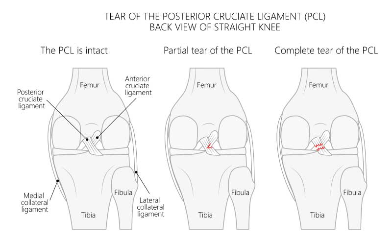 ACL and PCL Tear Posterior