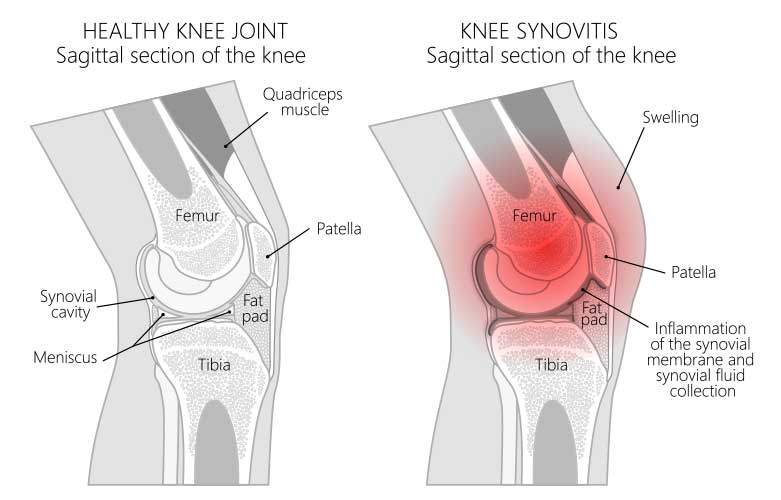 Knee Joint Swelling