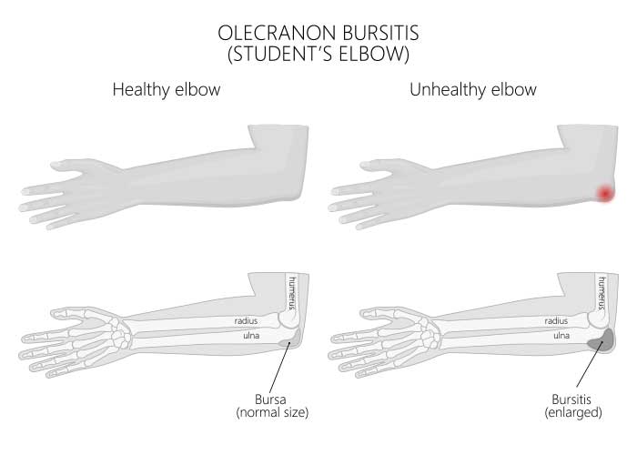 Elbow Bursitis