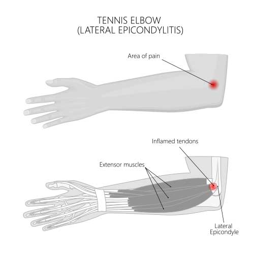 Tennis Elbow